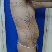 Abdominal Liposuction Gallery - Patient 3717644 - Image 1