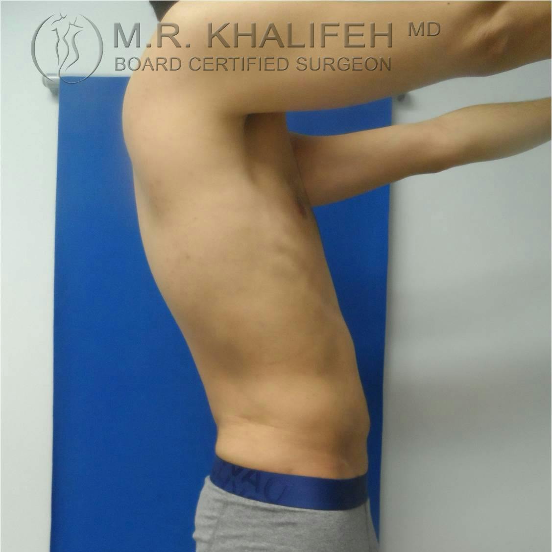 Abdominal Liposuction Gallery - Patient 3717644 - Image 2