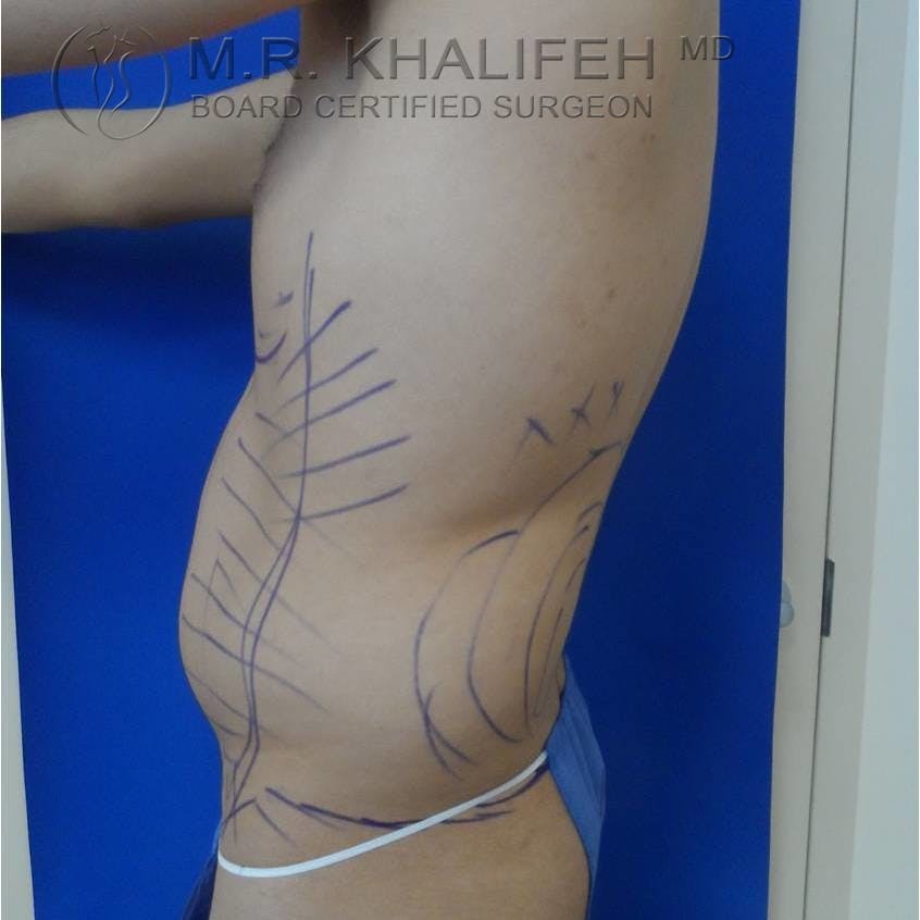 Abdominal Liposuction Gallery - Patient 3717644 - Image 3