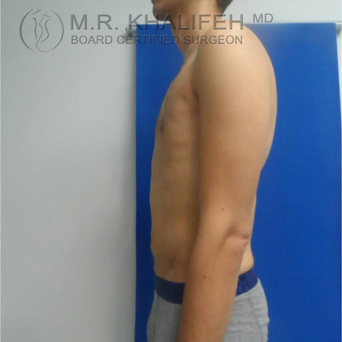 Abdominal Liposuction Gallery - Patient 3717644 - Image 4
