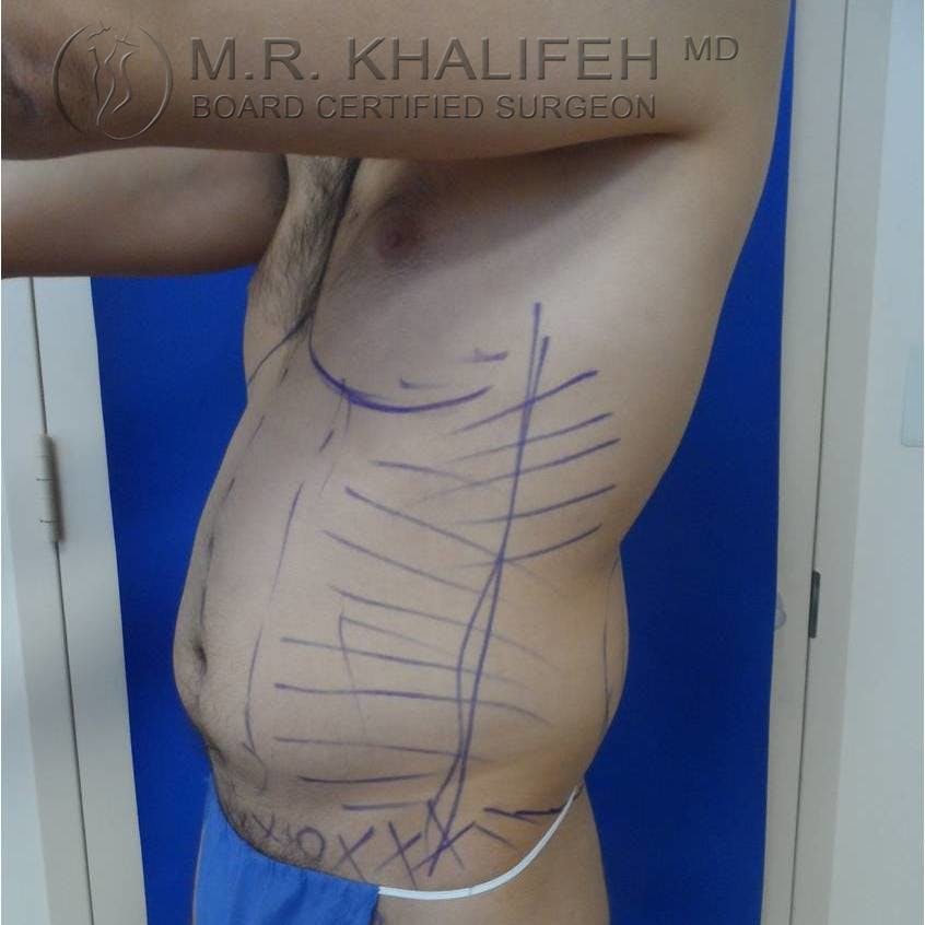 Abdominal Liposuction Gallery - Patient 3717644 - Image 5