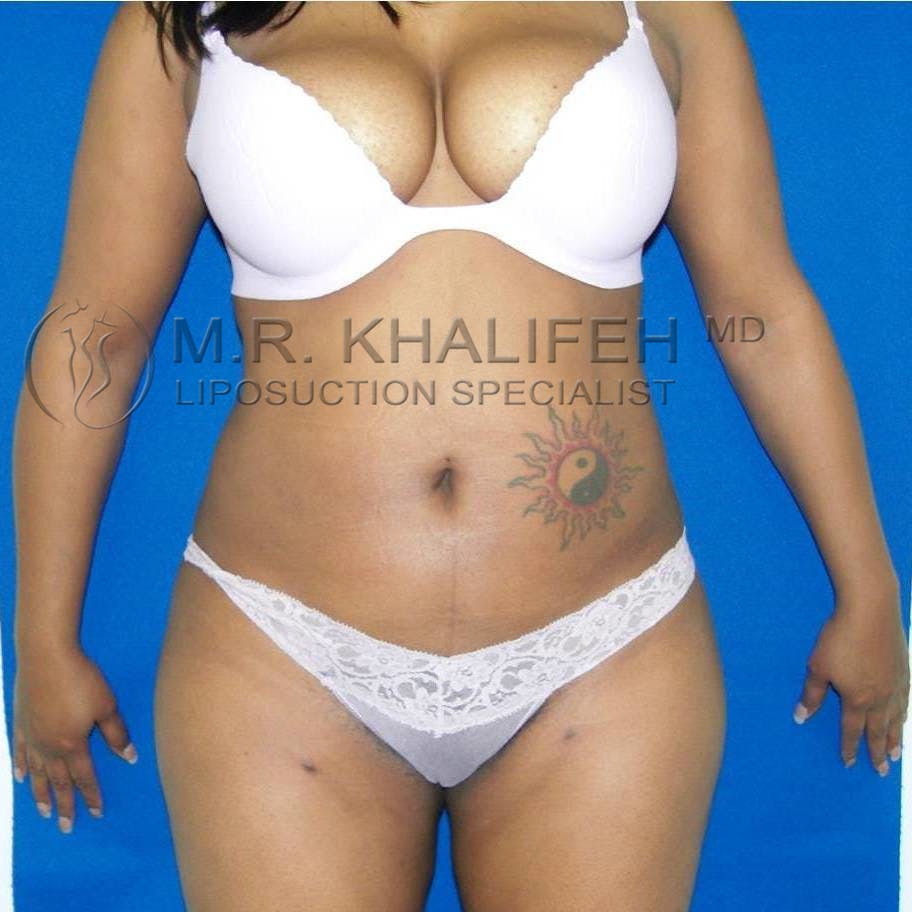 Abdominal Liposuction Gallery - Patient 3717647 - Image 2
