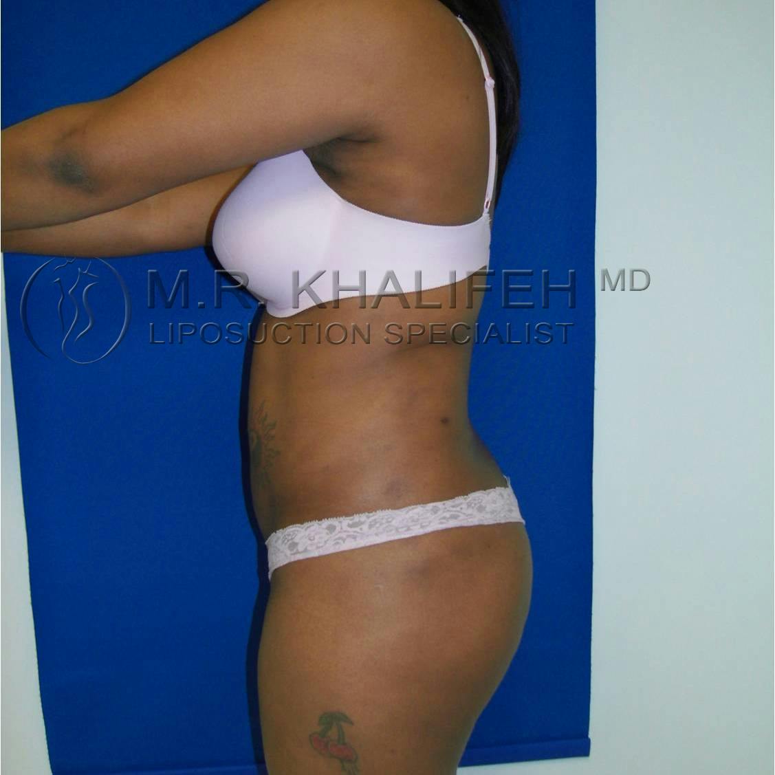 Abdominal Liposuction Gallery - Patient 3717647 - Image 4