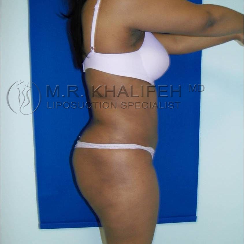 Abdominal Liposuction Gallery - Patient 3717647 - Image 6
