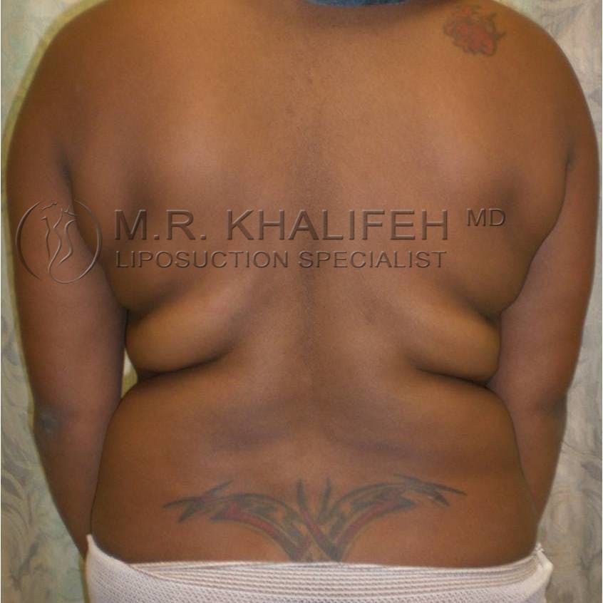 Abdominal Liposuction Gallery - Patient 3717647 - Image 7