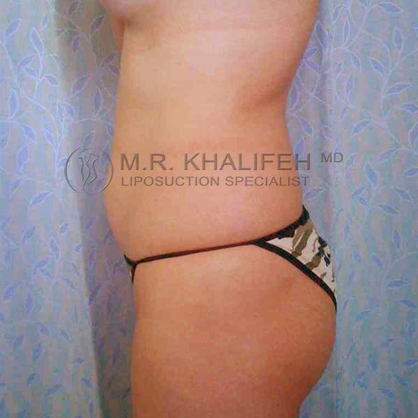 Abdominal Liposuction Gallery - Patient 3717650 - Image 3