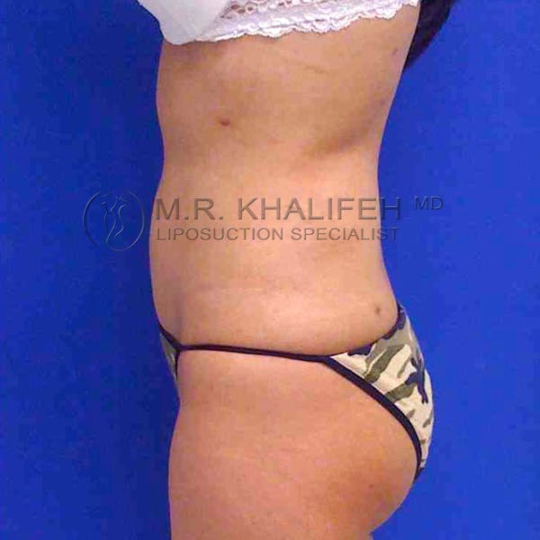 Abdominal Liposuction Gallery - Patient 3717650 - Image 4