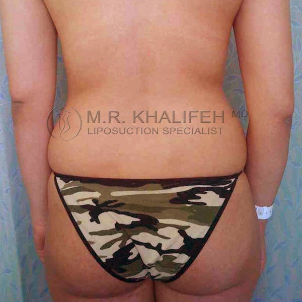 Abdominal Liposuction Gallery - Patient 3717650 - Image 5