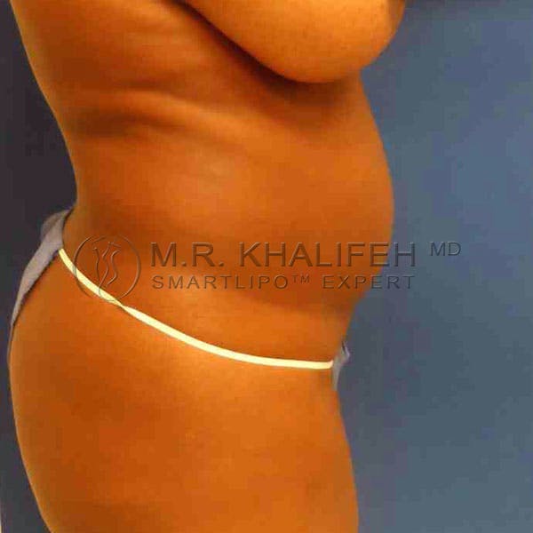 Abdominal Liposuction Gallery - Patient 3717737 - Image 5