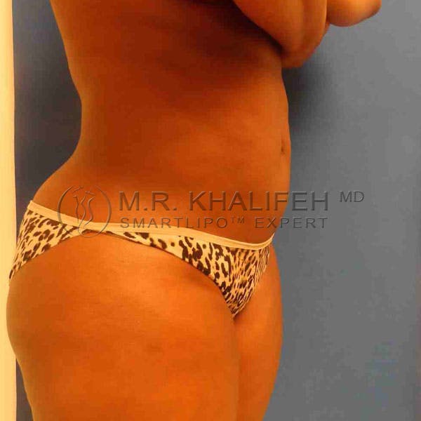 Abdominal Liposuction Gallery - Patient 3717737 - Image 6