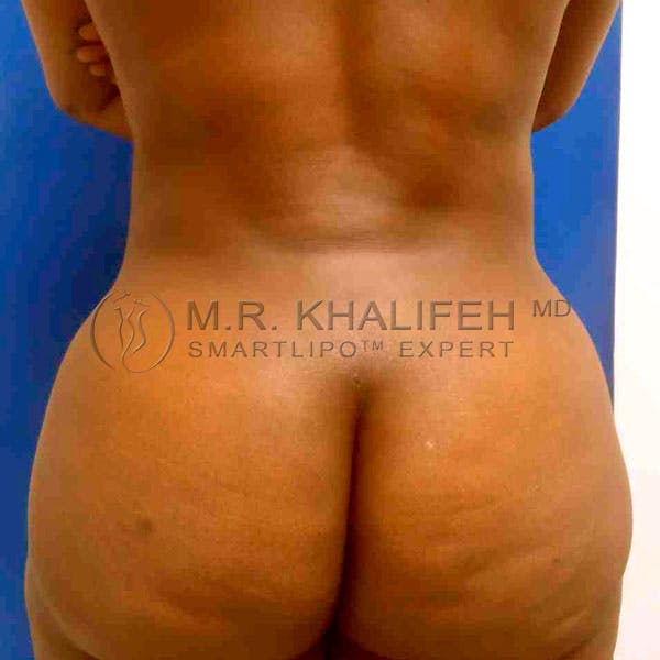 Abdominal Liposuction Gallery - Patient 3717737 - Image 8