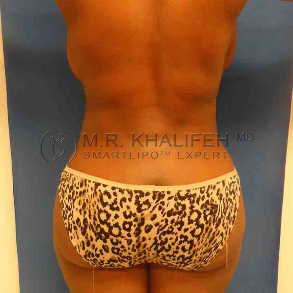 Abdominal Liposuction Gallery - Patient 3717737 - Image 10