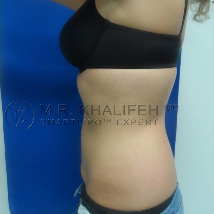 Abdominal Liposuction Gallery - Patient 3717843 - Image 4