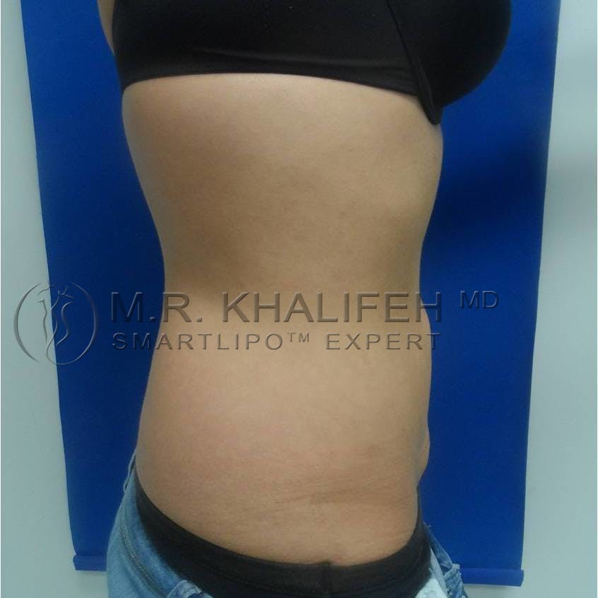 Abdominal Liposuction Gallery - Patient 3717843 - Image 6
