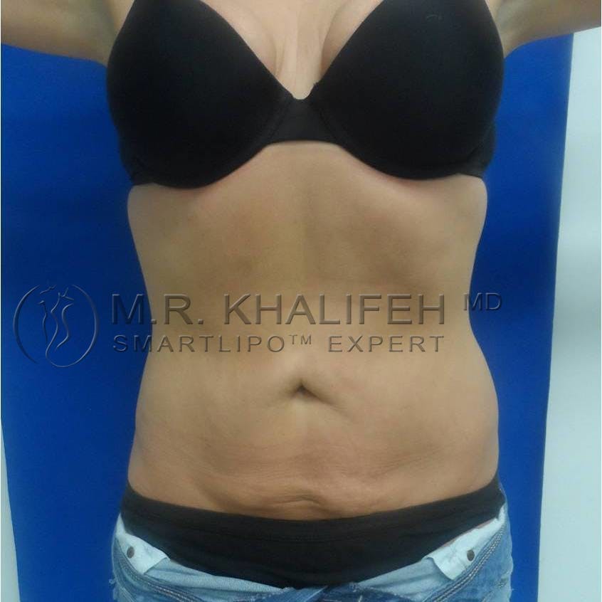 Abdominal Liposuction Gallery - Patient 3717843 - Image 2