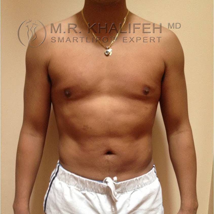 Abdominal Liposuction Gallery - Patient 3717987 - Image 2