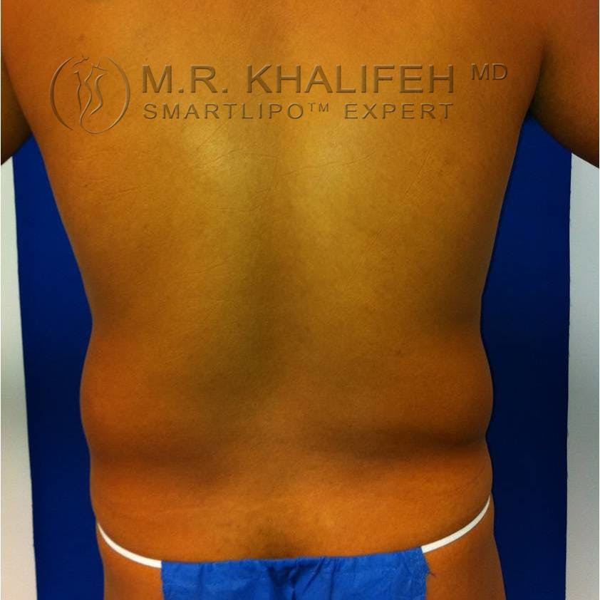 Abdominal Liposuction Gallery - Patient 3717987 - Image 3