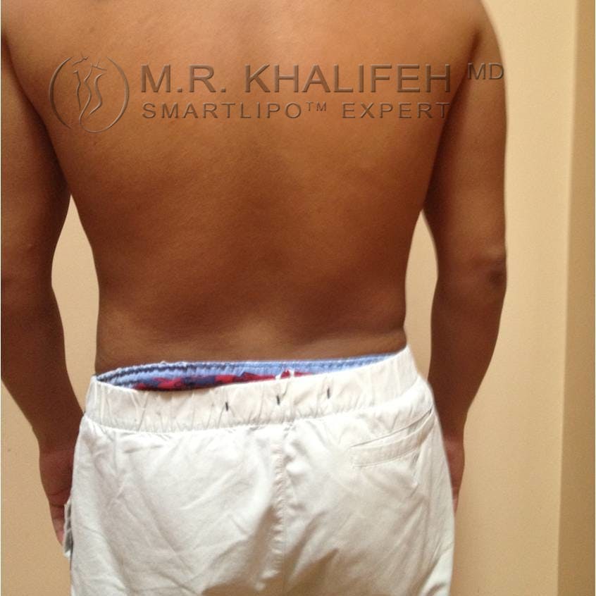 Abdominal Liposuction Gallery - Patient 3717987 - Image 4