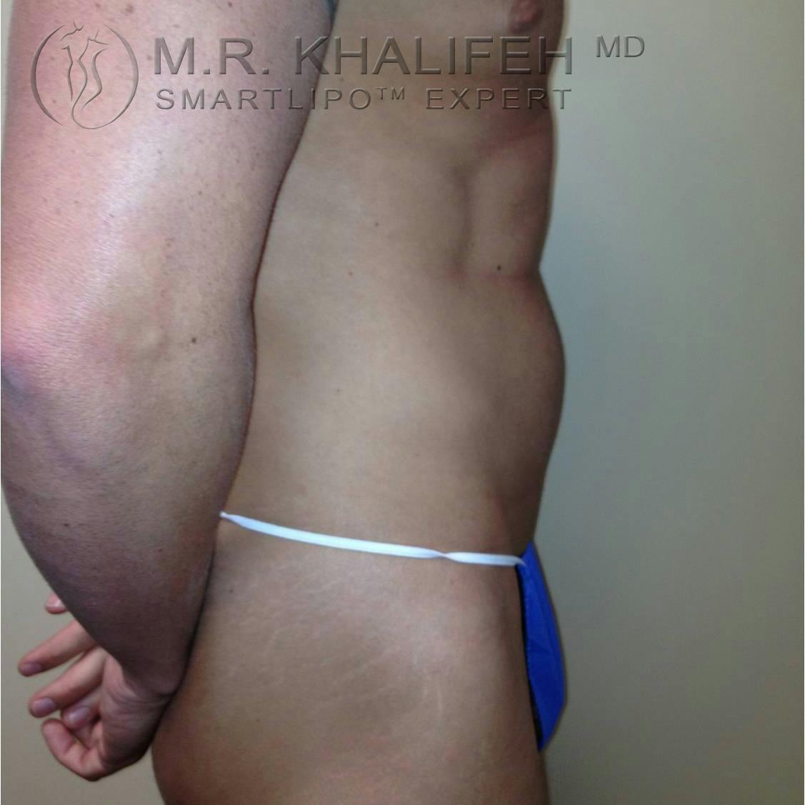 Abdominal Liposuction Gallery - Patient 3718044 - Image 3
