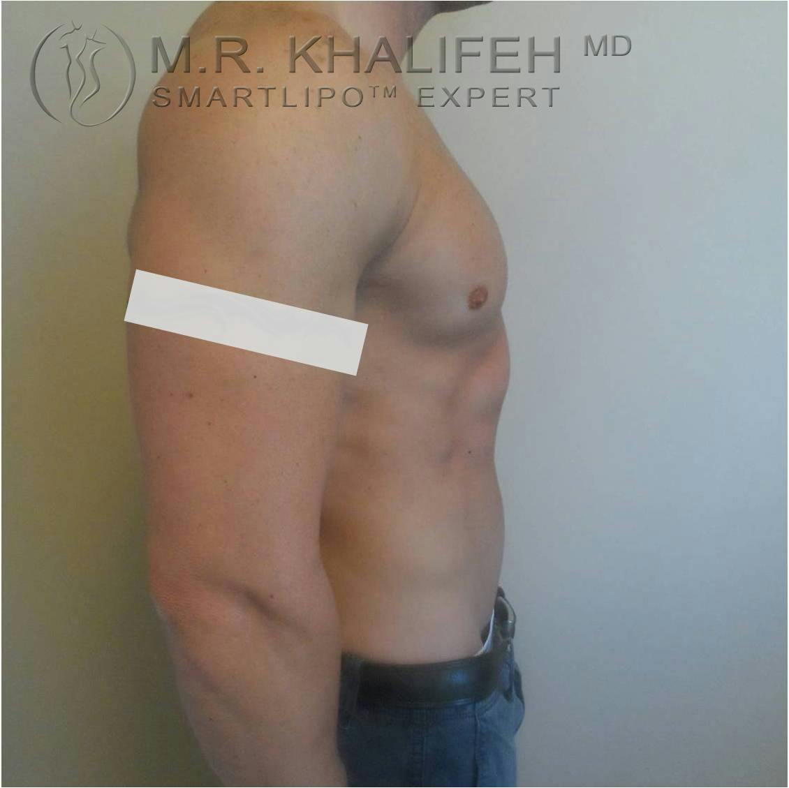 Abdominal Liposuction Gallery - Patient 3718044 - Image 4