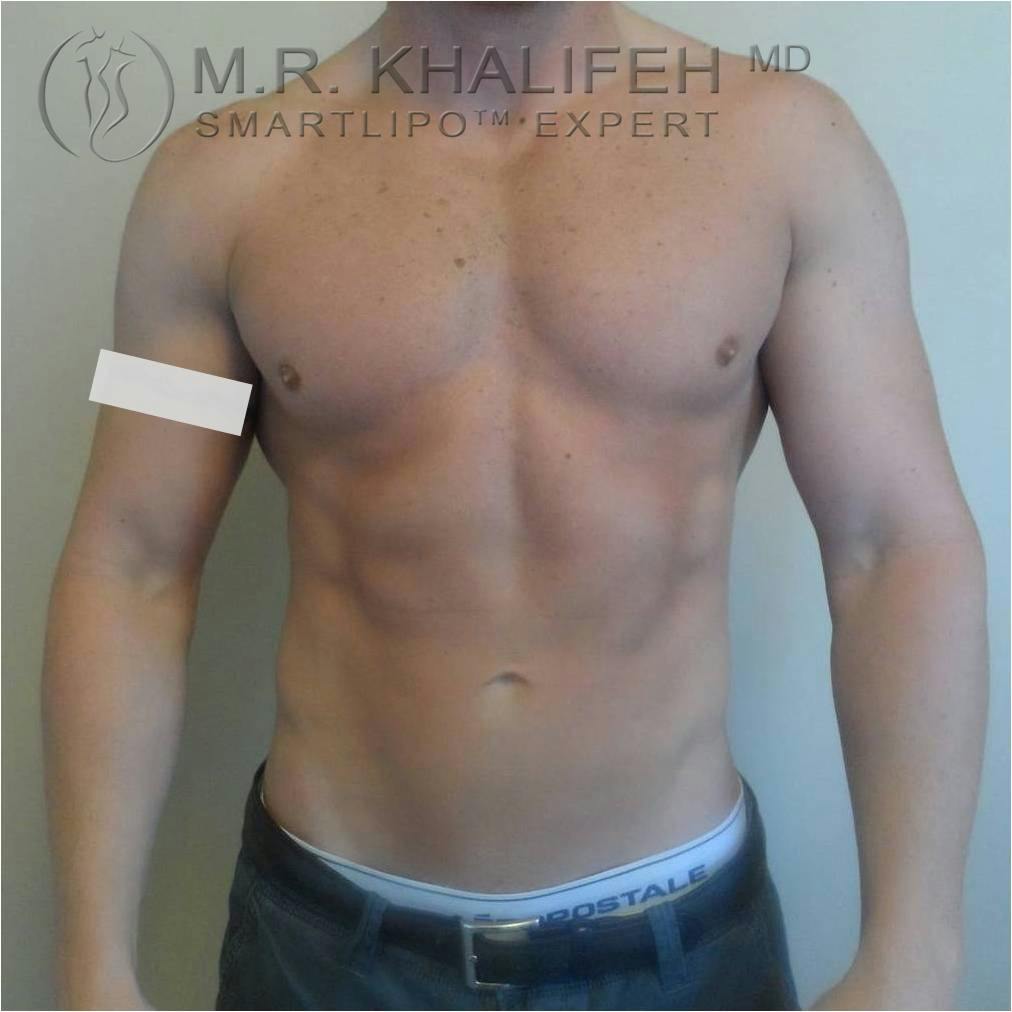 Abdominal Liposuction Gallery - Patient 3718044 - Image 2