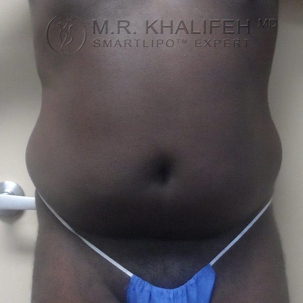 Abdominal Liposuction Gallery - Patient 3718120 - Image 1