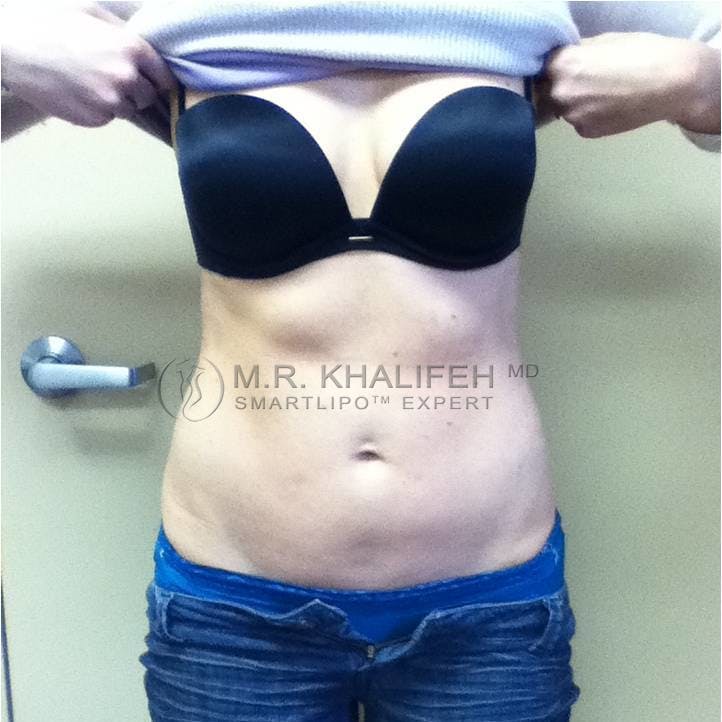 Abdominal Liposuction Gallery - Patient 3718171 - Image 2