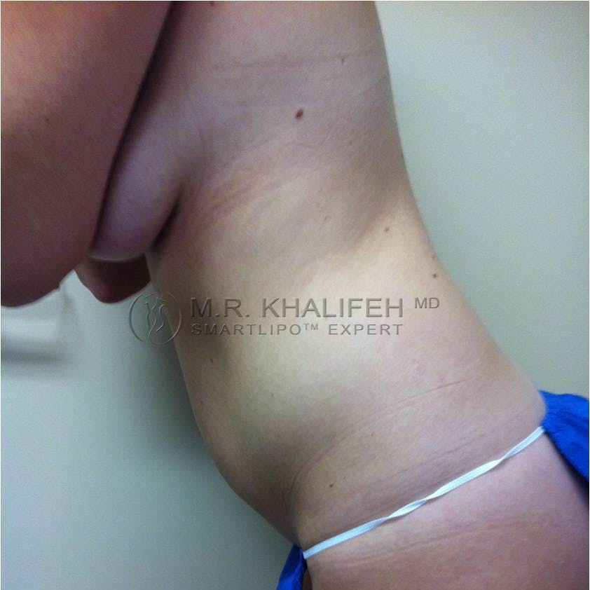 Abdominal Liposuction Gallery - Patient 3718171 - Image 3