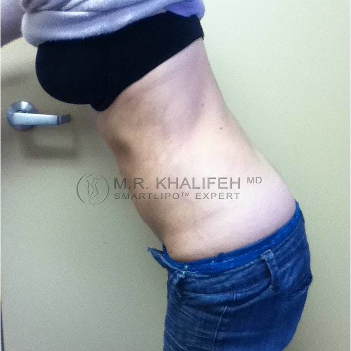 Abdominal Liposuction Gallery - Patient 3718171 - Image 4