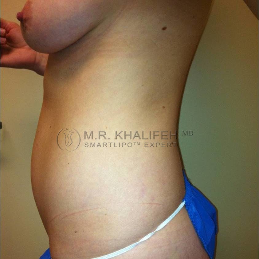 Abdominal Liposuction Gallery - Patient 3718171 - Image 5