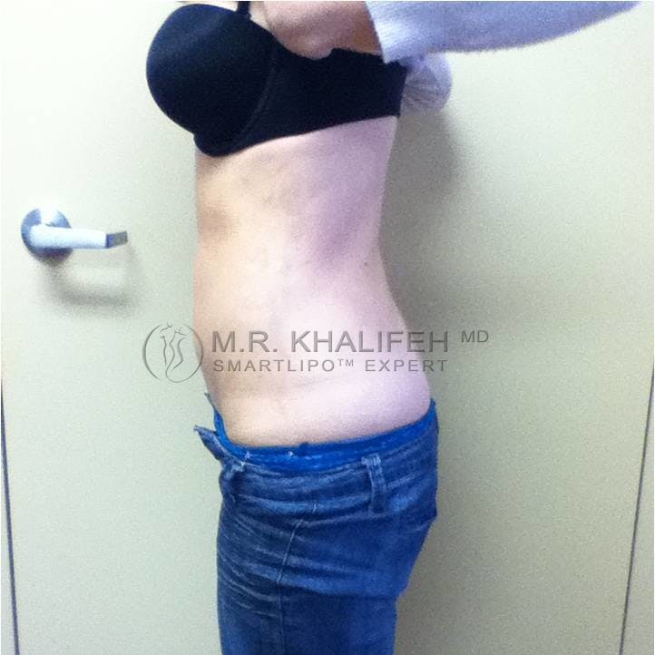 Abdominal Liposuction Gallery - Patient 3718171 - Image 6