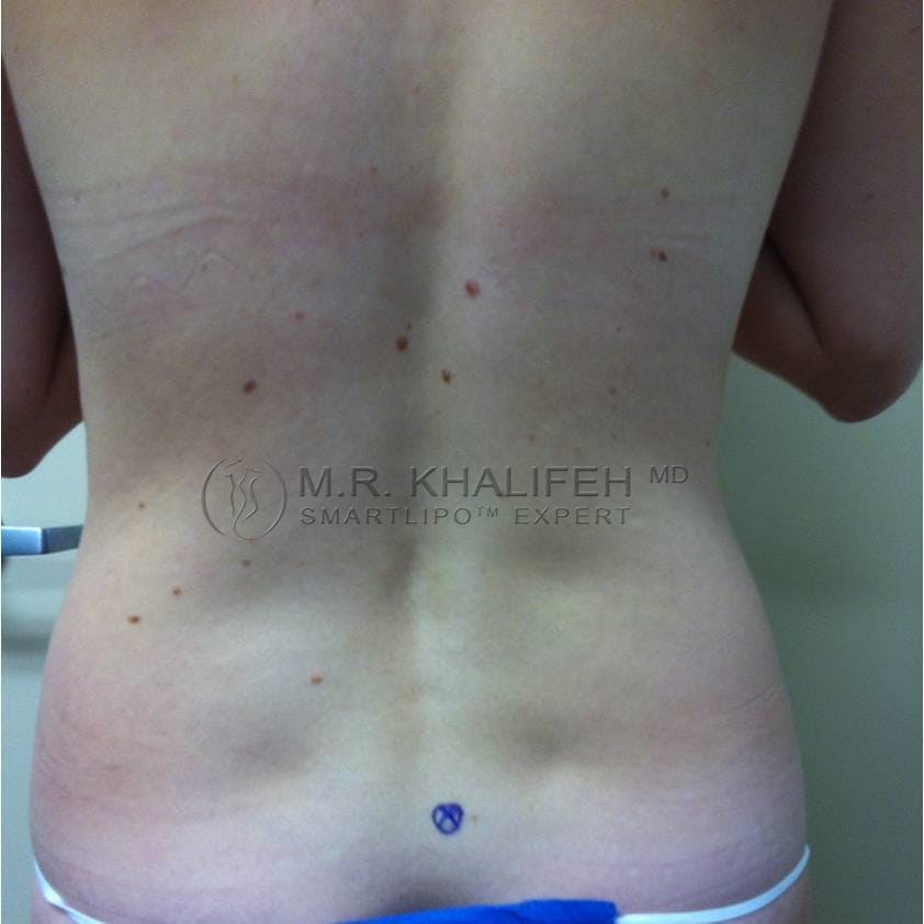 Abdominal Liposuction Gallery - Patient 3718171 - Image 7