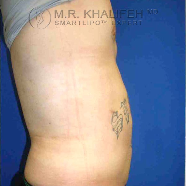 Abdominal Liposuction Gallery - Patient 3718225 - Image 4