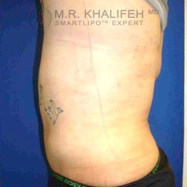 Abdominal Liposuction Gallery - Patient 3718225 - Image 8