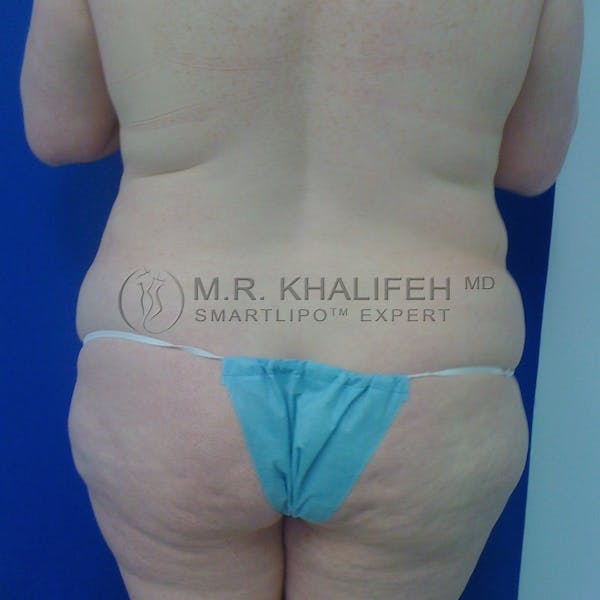 Abdominal Liposuction Gallery - Patient 3718291 - Image 5