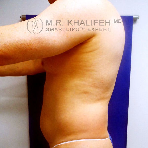 Abdominal Liposuction Gallery - Patient 3718359 - Image 7