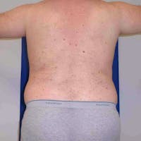 Flank-Lower Back Liposuction Gallery - Patient 3718600 - Image 1