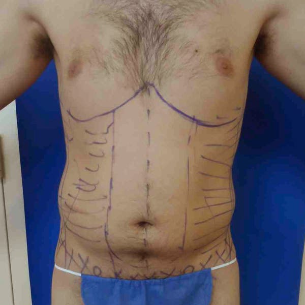 Flank-Lower Back Liposuction Gallery - Patient 3718656 - Image 3
