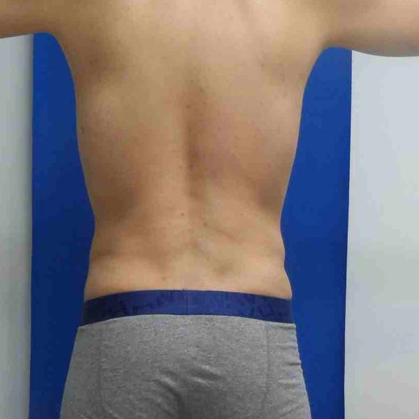 Flank-Lower Back Liposuction Gallery - Patient 3718656 - Image 4