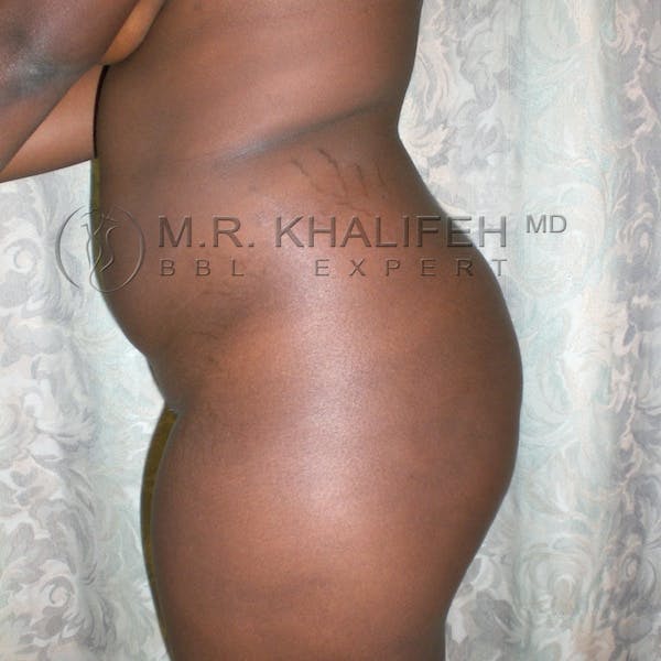 Flank-Lower Back Liposuction Gallery - Patient 3718726 - Image 3
