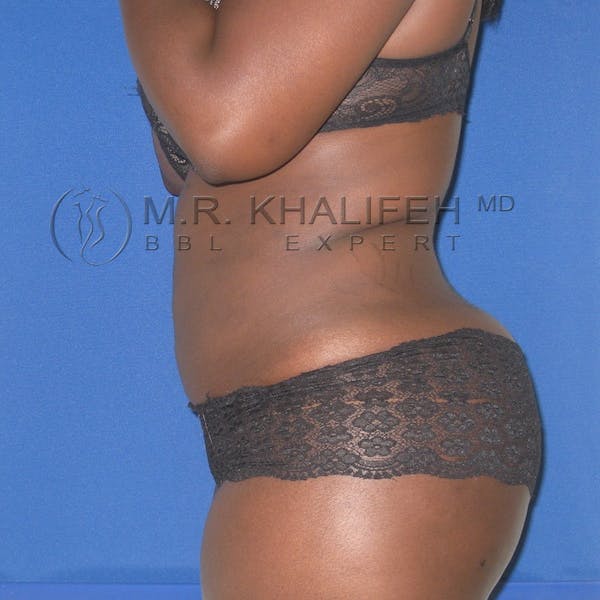 Flank-Lower Back Liposuction Gallery - Patient 3718726 - Image 6