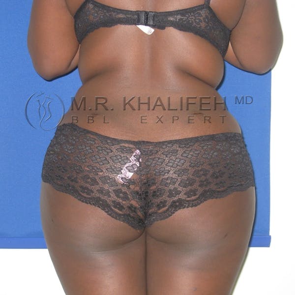 Flank-Lower Back Liposuction Gallery - Patient 3718726 - Image 2
