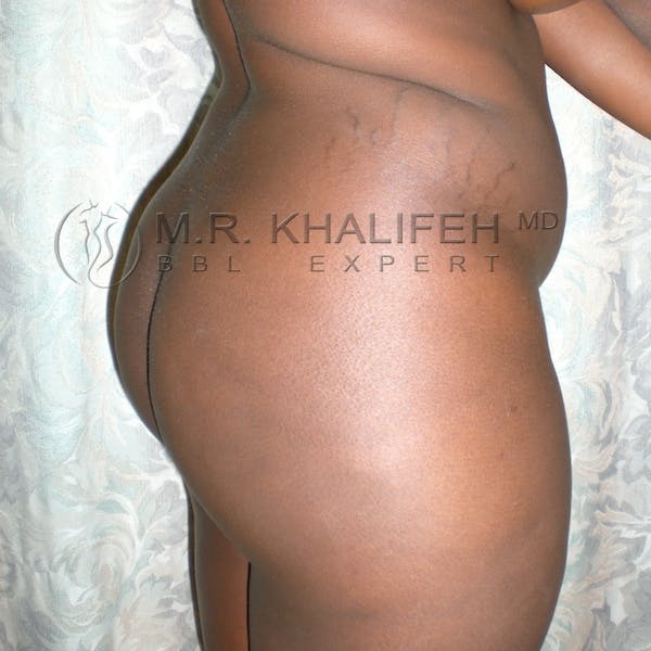 Flank-Lower Back Liposuction Gallery - Patient 3718726 - Image 7