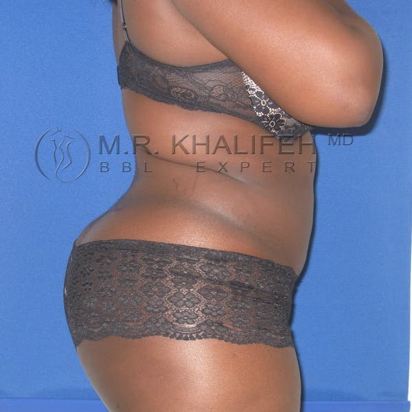 Flank-Lower Back Liposuction Gallery - Patient 3718726 - Image 8