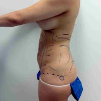 Flank-Lower Back Liposuction Gallery - Patient 3718763 - Image 1
