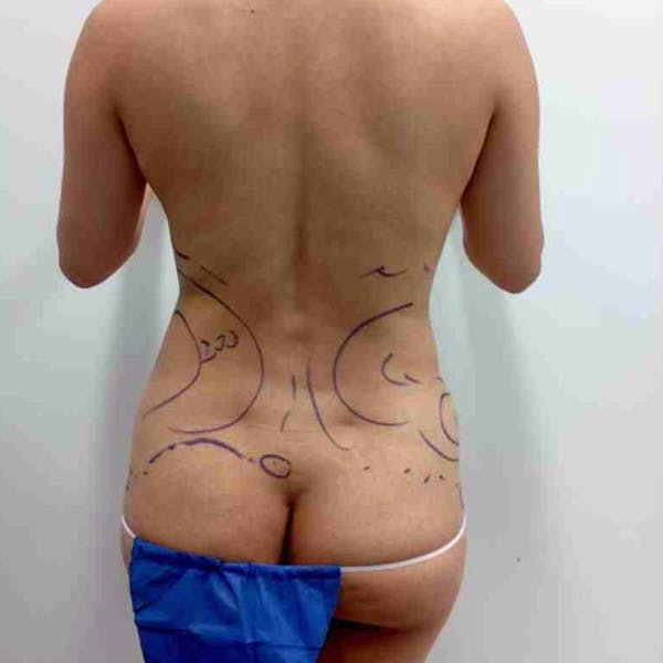 Flank-Lower Back Liposuction Gallery - Patient 3718763 - Image 3