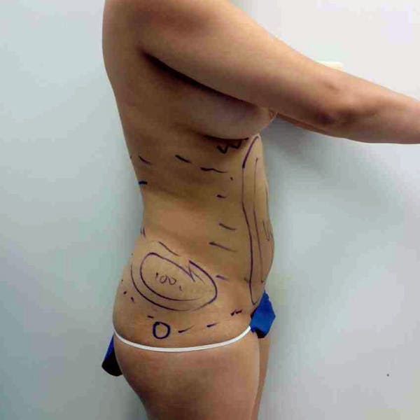 Flank-Lower Back Liposuction Gallery - Patient 3718763 - Image 5