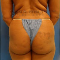 Flank-Lower Back Liposuction Gallery - Patient 3718843 - Image 1