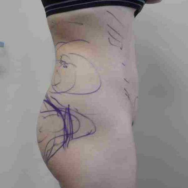 Flank-Lower Back Liposuction Gallery - Patient 3718871 - Image 1
