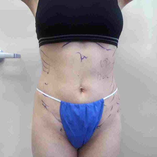 Flank-Lower Back Liposuction Gallery - Patient 3718871 - Image 5